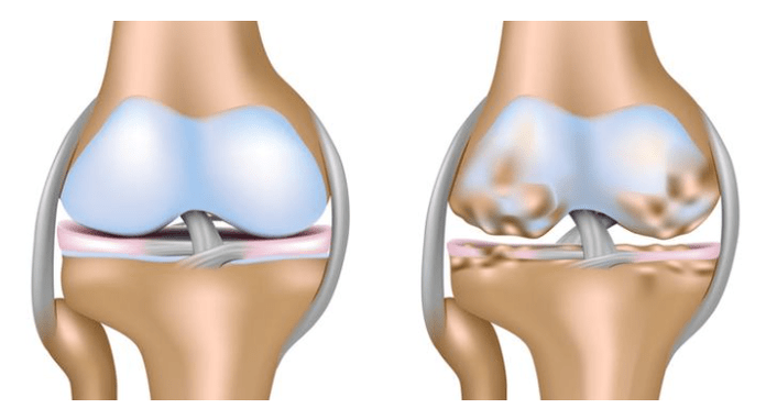 здрава хрскавица и оштећење коленског зглоба са артрозом