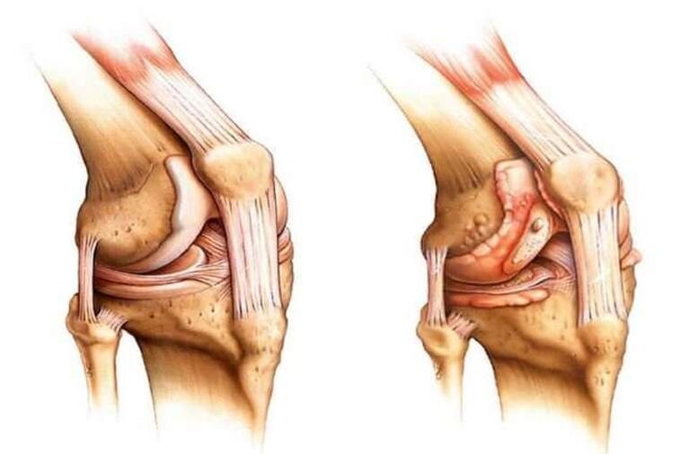 здраво колено и артроза коленског зглоба