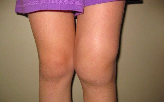отечен коленски зглоб због остеоартритиса
