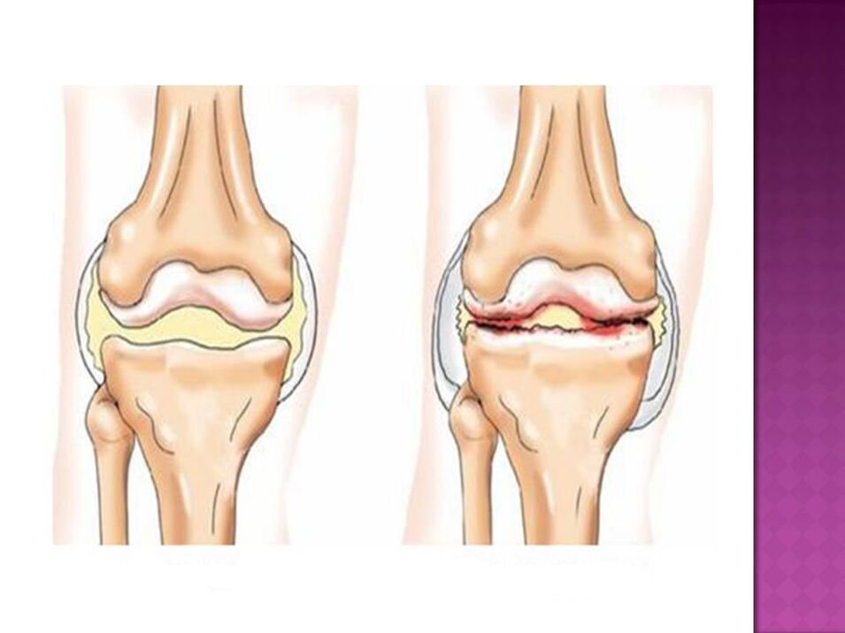 Зглоб је нормалан (лево) и захваћен остеоартритисом (десно)
